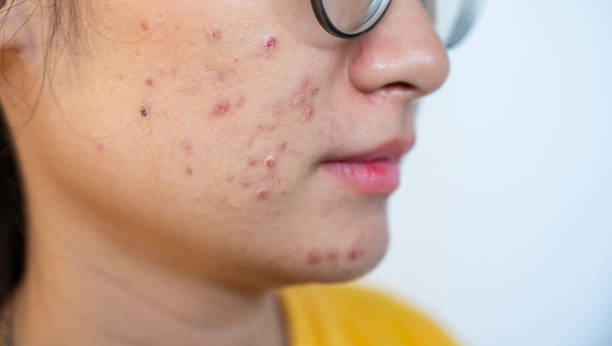 Acne